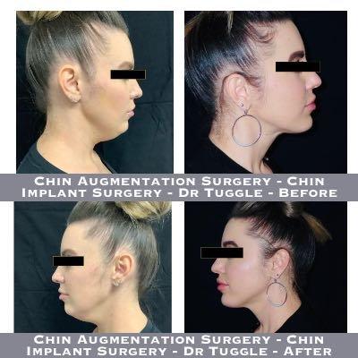 Chin Augmentation Surgery - Chin Implant Surgery - Dr Tuggle - Before-After