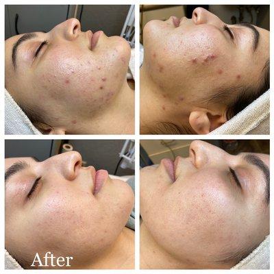 Acne Solutions Skin Care & Spa