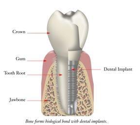 Compare tooth with implant