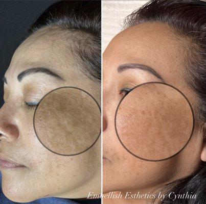 Hyper pigmentation, chemical peel by Cynthia S.