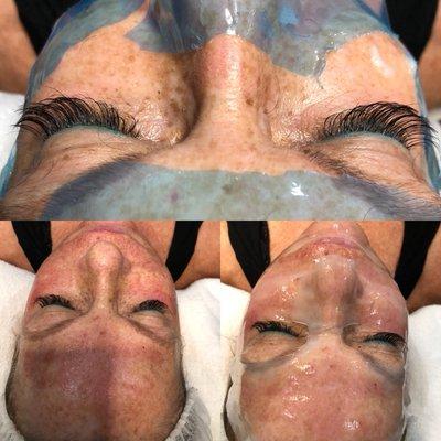 Microneedling prep and after treatment @Skinfrenzy