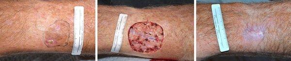 Before melanoma removal, after removal and 2 months after healing by itself (no sutures). Mother Nature scores again!