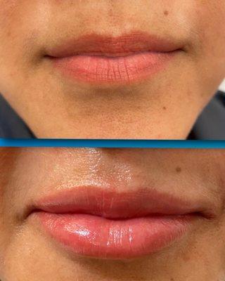 A gentle touch with Versa filler makes a huge difference!!