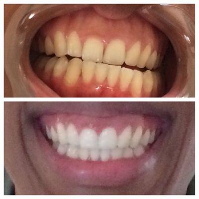 Teeth whitening