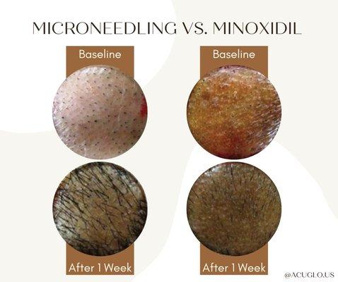 Comparison close up of microneedling versus minoxidil. AcuGlo offers microneedling services in combination with acupuncture in Burbank, CA.