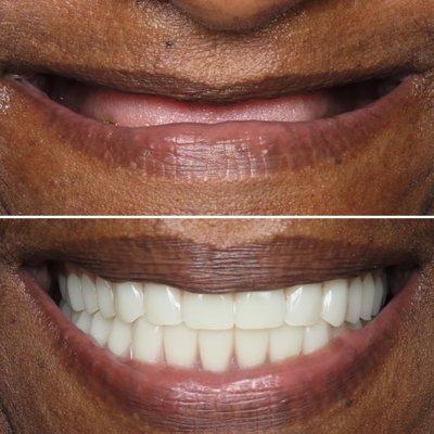 Implant retained dentures completed by Dr. Rob