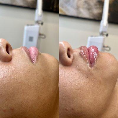 Lip filler