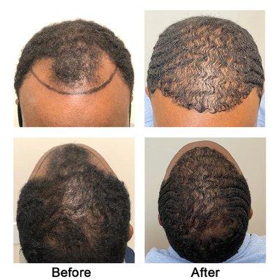 AZ Hair Restoration