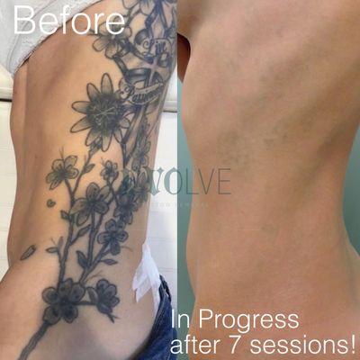 This patient had very large tattoos that were no match for our Astanza laser.