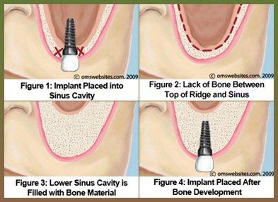 Why sinus needed