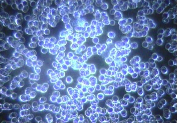 Blood cells declumping directly after a hyperbaric oxygen session.