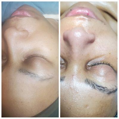 Bioelements Custom Facial, Before and After.