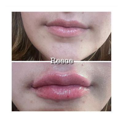 0.5cc's Lip Filler