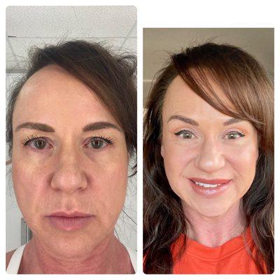 Upper eyelid lift before and after