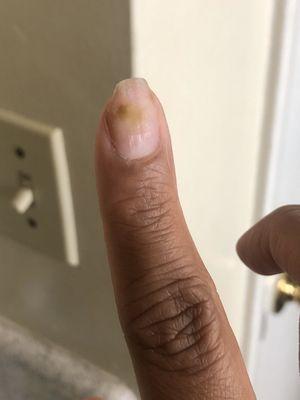 My nail now infected after 3 weeks of wearing the gel acrylics.