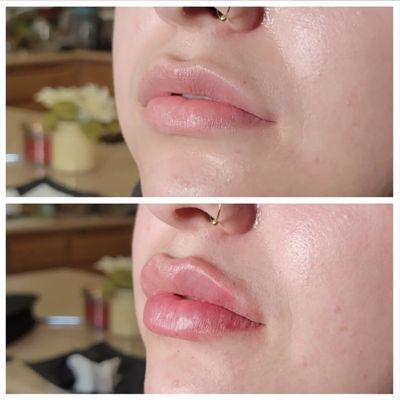 Before and after lip filler using Restylane Kysse.