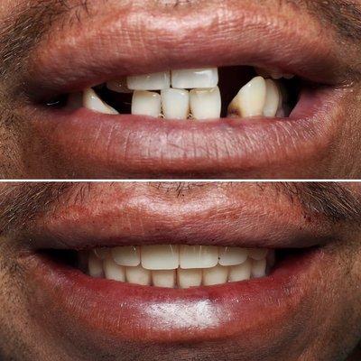 Upper and lower implant dentures to replace hopeless dentition.