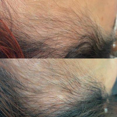 Hair restoration by Keralase