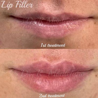 Lip filler  Dr Montejano offers Lip Filler!