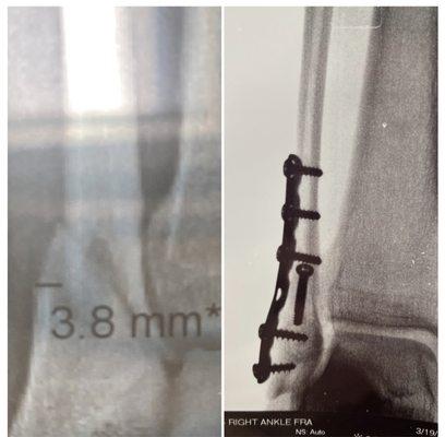 3.8 mm fracture. Bionic now.