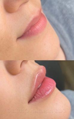 Before & after lip filler by Sean!