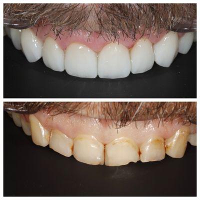 Smile makeover using Porcelain Veneers