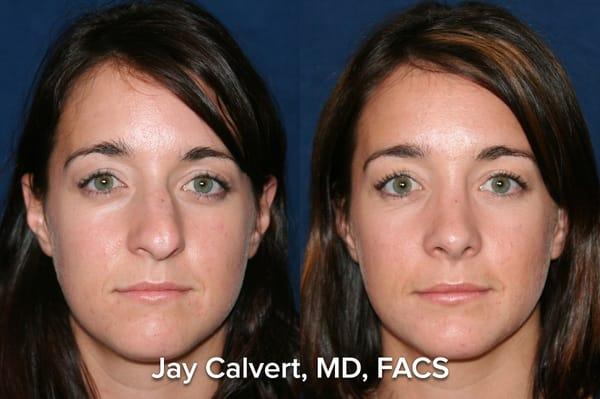 Primary Rhinoplasty by Dr. Jay Calvert