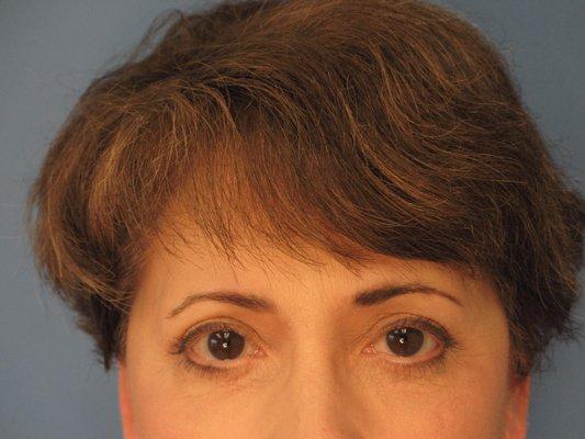 Blepharoplasty Patient 1 (After)