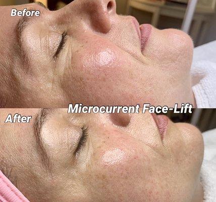 Microcurrent Face Lift facial treatment