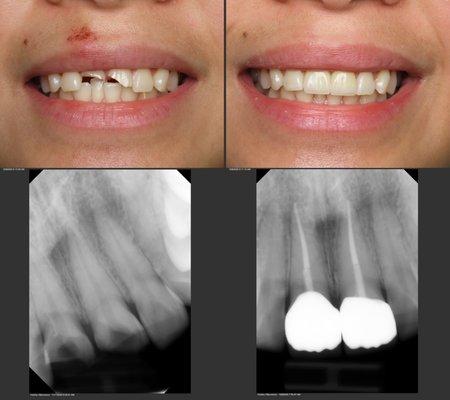 restore two front teeth after accident