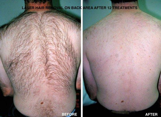 Laser Hair Removal after 12treatments