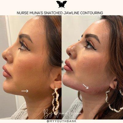 Nurse Muna's Jawline Contouring