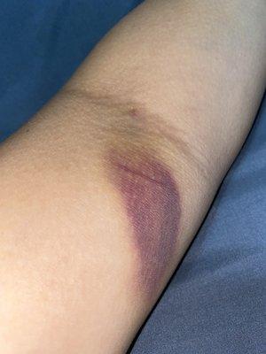 bruising...not sure if it's worth it? definitely not for the faint of heart.