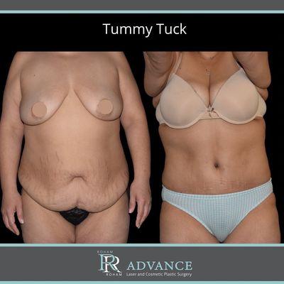 Tummy Tuck before and after