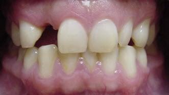 Dental Implant Before