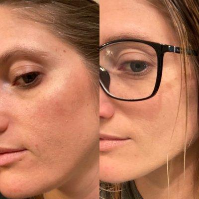 Before and after 6 weeks of a cleanser and moisturizer routine.