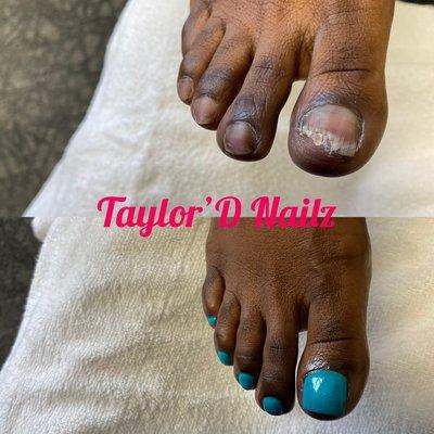 Toenail Restoration with waterless pedicure.