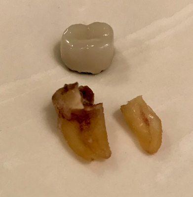 The same fragments with the top of the crown, which was basically holding the tooth together.