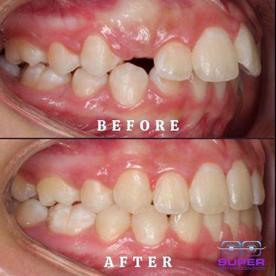 Before and After Treatment Case