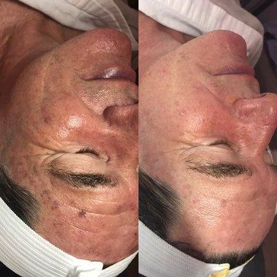 Before and after enzyme peel and Rezenerate Facial