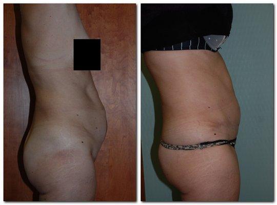 Before and after an abdominoplasty (tummy Tuck)