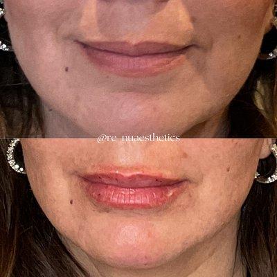 BEFORE & AFTER lip filler