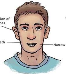 Flat Cheeks, Crowded Teeth, Narrow Face