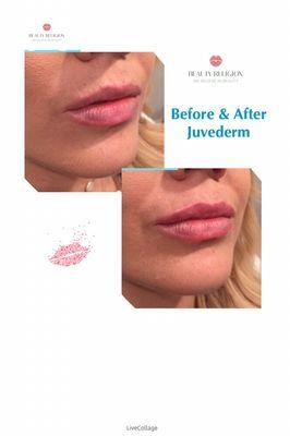 Before and after Juvederm lip augmentation