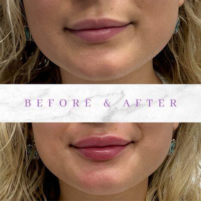 Before and after lip filler treatment