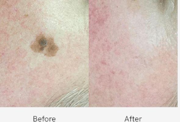 Seborrheic Keratosis NYC