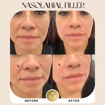 Nasolabial filler (smile lines filler)