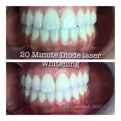 Teeth whitening before & after