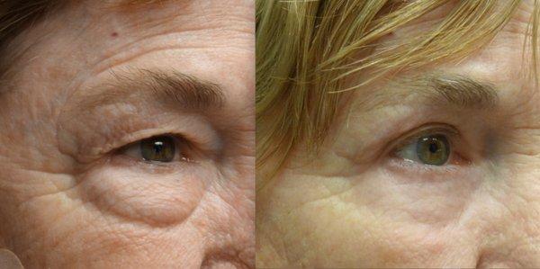 Before and After Upper and Lower Eyelid Surgery