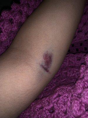 Bruise left by the Asian woman who drew my blood.  I've never bruised like this after bloodwork.